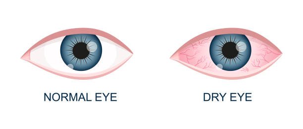 Dry Eyes Symptoms