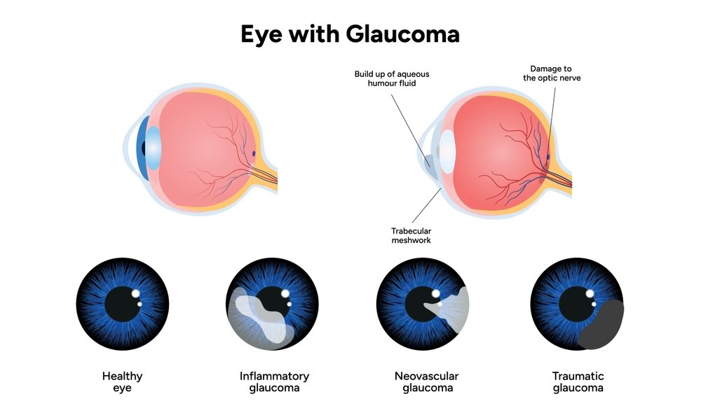 Glaucoma Symptoms