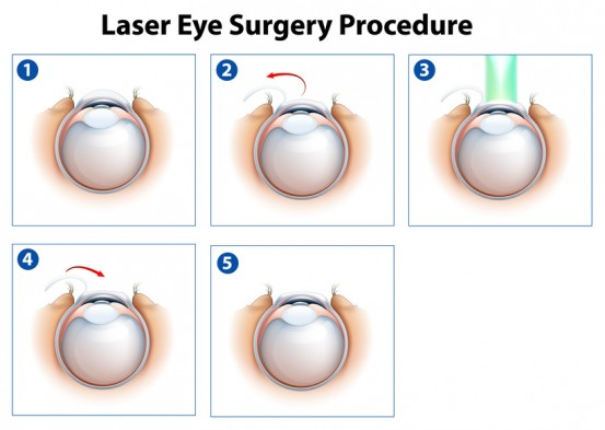 Lasik Surgery Procedure