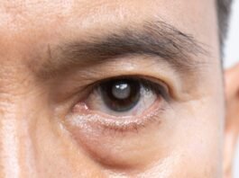 What Is Glaucoma