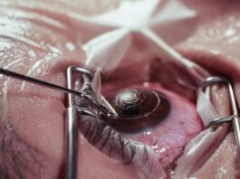 What Is Lasik Surgery