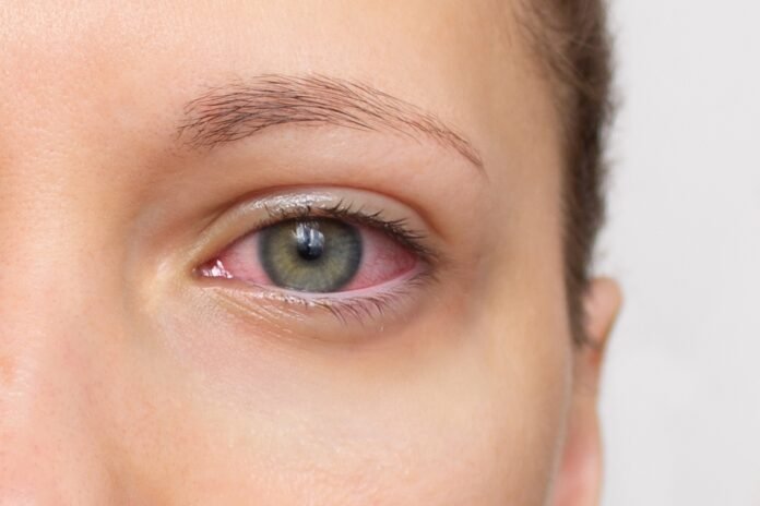 What Is The Best Treatment For Severe Dry Eyes