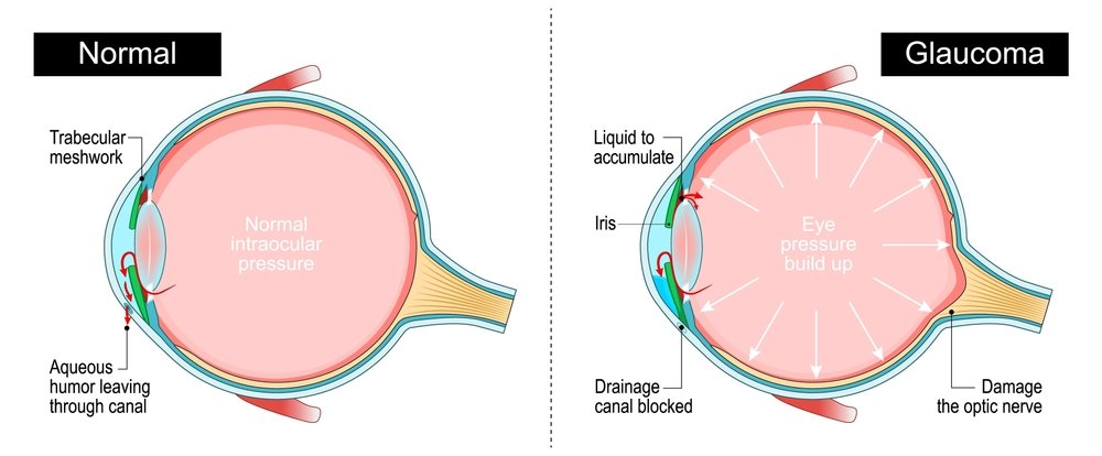 glaucoma